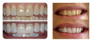 ข้อดีของการฟอกสีฟันด้วยวิธี Opalescens
