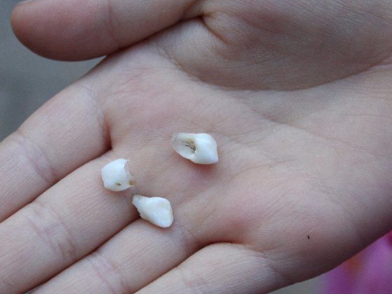 ฟันน้ำนม ฟันน้ำนมของ Kogla หลุดออกมา