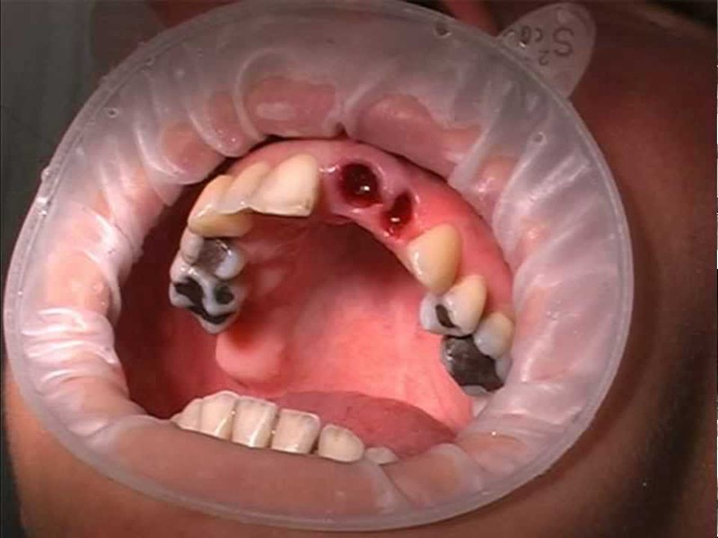 Alveolitis ต่อต้านการถอนฟัน
