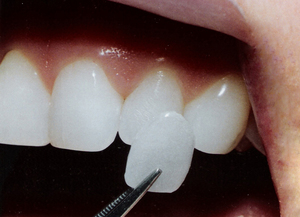 การติดตั้งแผ่นไม้อัด Hollywood Veneers