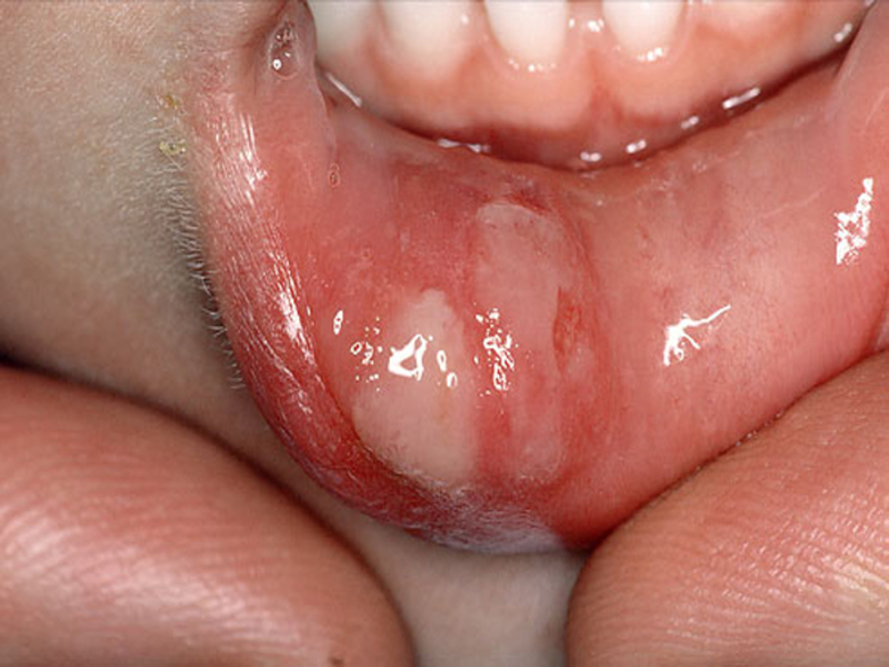 Aphthous stomatitis: อาการและการรักษา วิธีการรักษาเปื่อยอักเสบ