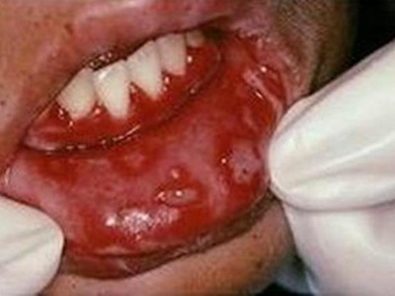 Ulcerative stomatitis อาจพัฒนาจากขั้นสูงของ starritis catarrhal สาเหตุของการเกิดแผลเปื่อยที่ปาก