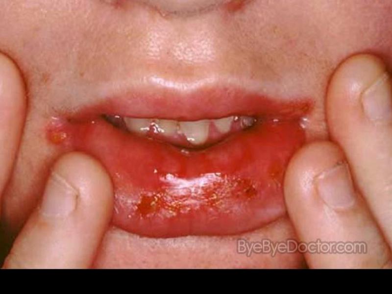 Herpetic (เริม) เปื่อยในเด็กและผู้ใหญ่ วิธีการรักษาโรคปากอักเสบติดเชื้อ
