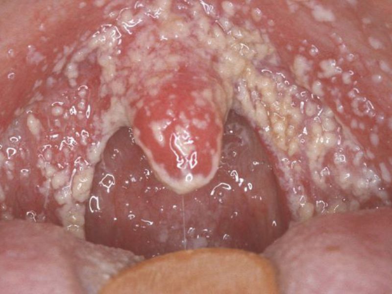Candida stomatitis เป็นกระบวนการอักเสบในช่องปากของสาเหตุของเชื้อรา คำแนะนำสำหรับการรักษาปากมดลูกอักเสบในเด็ก
