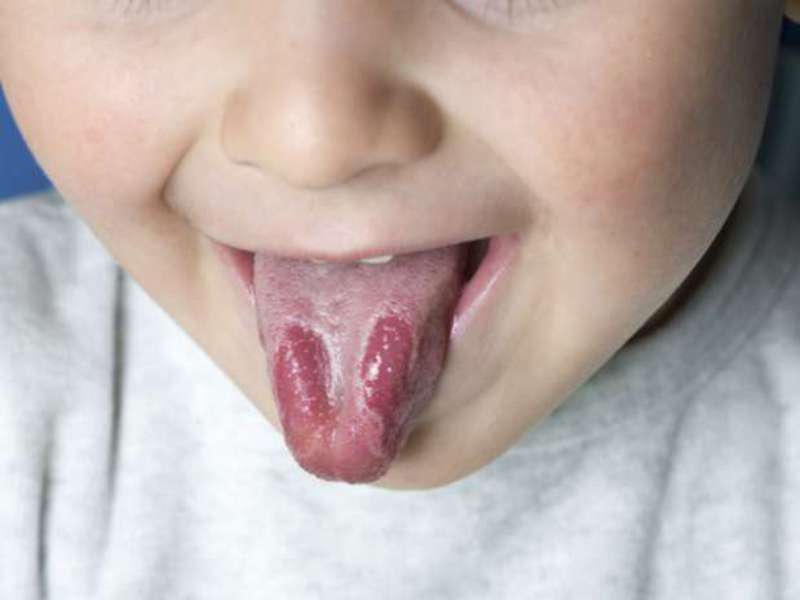 อะไรเป็นสาเหตุของ Candida stomatitis (นักร้องหญิงอาชีพ) วิธีการรักษาปากมดลูกอักเสบในเด็ก