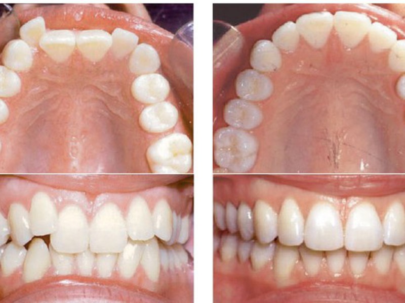 ผลการจัดฟันแบบ Ivisalign