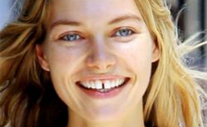 Diastema สามารถทำลายรอยยิ้มได้