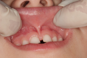 การตรวจด้วยสายตาที่ทันตแพทย์สามารถเปิดเผย diastema