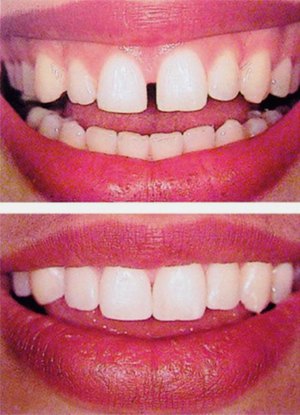หลังการรักษา diastema จากช่องว่างระหว่างฟันและไม่มีร่องรอย