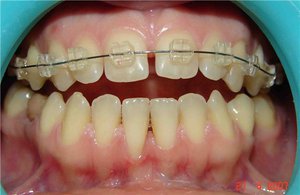 การรักษาโรคกระดูกและข้อของ diastema วิธีการเกี่ยวกับศัลยกรรมกระดูกเกี่ยวข้องกับการใช้เครื่องมือจัดฟัน
