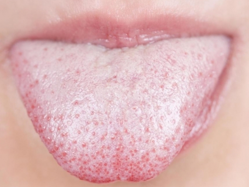 บานสีขาวในผู้ใหญ่ อะไรคือเหตุผลที่บานสีขาวบนลิ้น