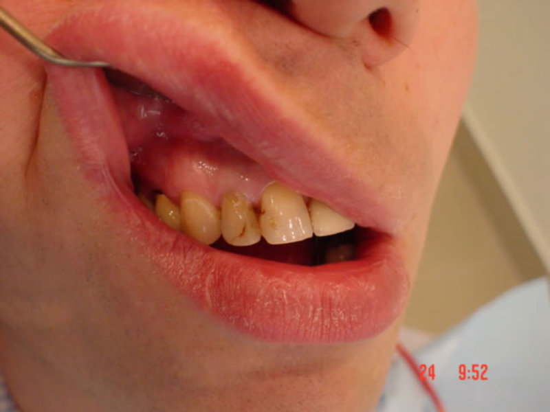 ฟันน้ำนม ซีสต์บนเหงือก