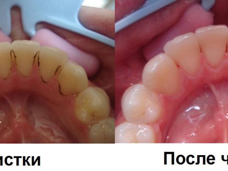 วิธีการกำจัดคราบหินปูน วิธีกำจัดคราบจุลินทรีย์